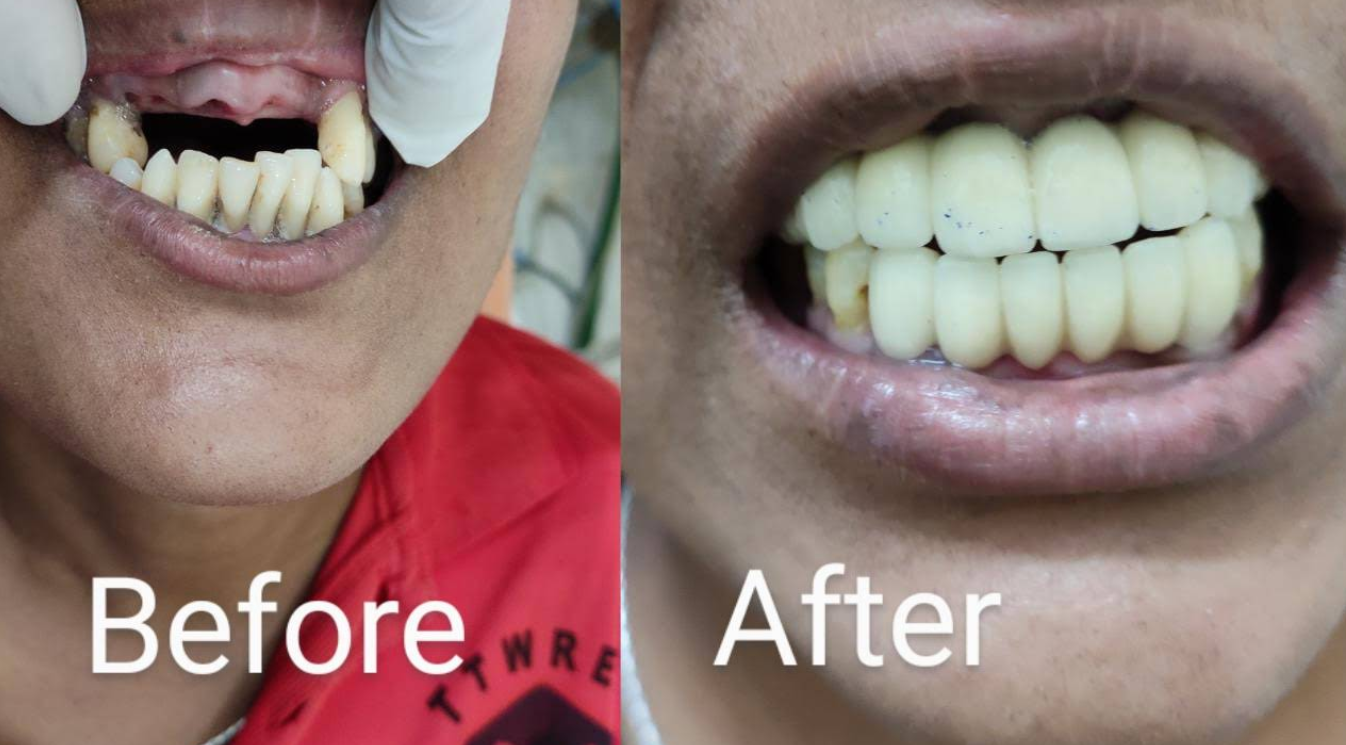 Before and after dental transformation